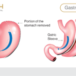 Gastric Sleeve Surgery: A Path to Effective Weight Loss and Optimal Health