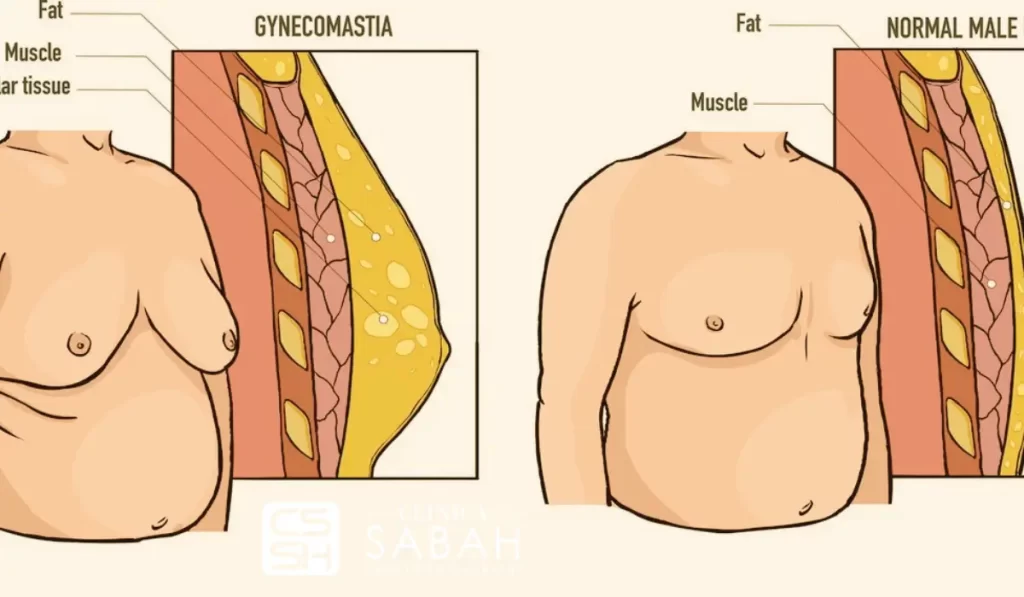تضخم الثدي عند الرجال