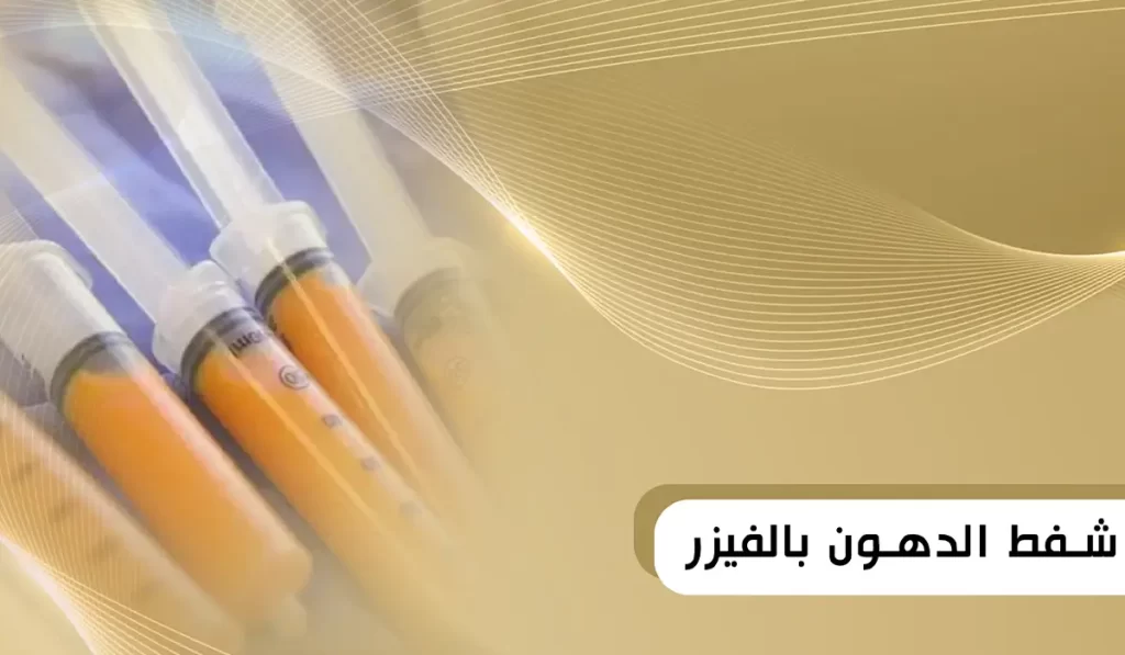 شفط الدهون بالفيزر